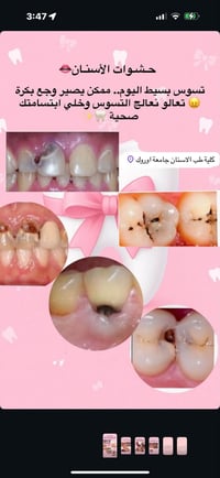 علاج اسنان مجاني • حشوات تجميلية • الكرادة جامعة أوروك