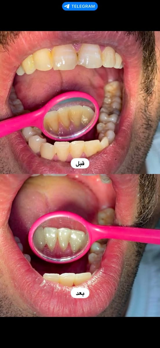 الدكتورة دانية الشمري
📍 كربلاء – عيادات جامعة الزهراوي
✨ العلاج مجاني ✨
الشغل موضح بالصور

📞 للحجز أو الاستفسار واتساب: ***********

عندك تصبغات أو تكلسات بالأسنان؟
احجز جلسة تنظيف حتى ترجع ابتسامتك المشرقة ✨

سن عقل ، سن مكسور، متآكل، أو باقي منه الجذر فقط؟
نقوم بقلع السن بكل راحة وأمان،
وبإشراف جرّاح اختصاص

تعاني من تسوّس؟
عالج السن قبل ما يوصل للجذر
 
اسنان اطفالك محتاجك علاج ؟
احجز موعدك اليوم وخلي ابتسامتك أجمل

