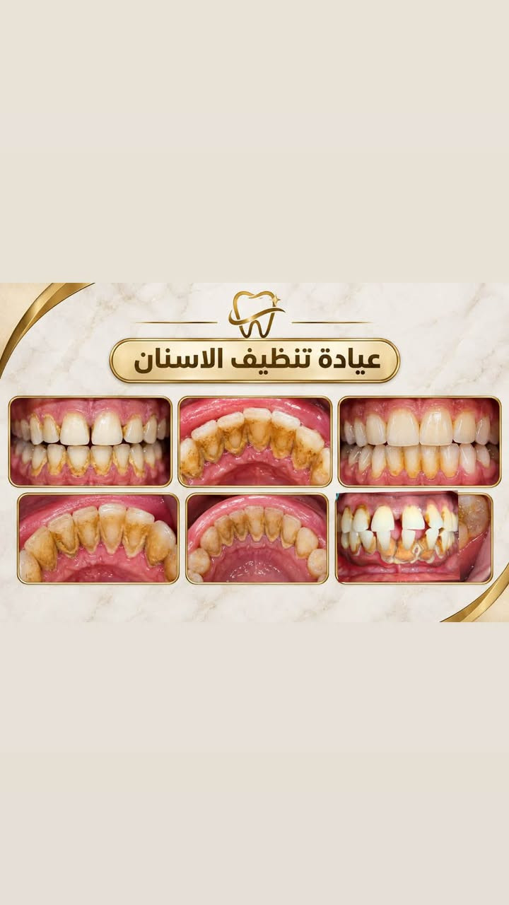 الـسلام عليكم
العلاج مجـاني  بالكامل 
متوفر قلع الاسنان التالفة وبقايا الجذور وتعويضها بطقم متحرك تنظيف حشوات ضوئية كلشي معقم ونظيف تحت اشراف اطباء مختصين

نص مكتوب في الصور:
- دكتورة زينب فرحان طالبة طب وجراحة الفم والأسنان الخدمات المتوفرة قلع الأسنان حشوات تجميلية تركيب طقم أسنان تنظيف الأسنان مكان العيادة كلية طب الأسنان جامعة دجلة *********** @bk__ares نعني بابتسامتك لأنك تستحق الأفضل
- عيادة تنظيف الاسنان
- عيادة القلع
- عيادة الحشوات
- عيادة ( طقم الاسنان الجزئي )