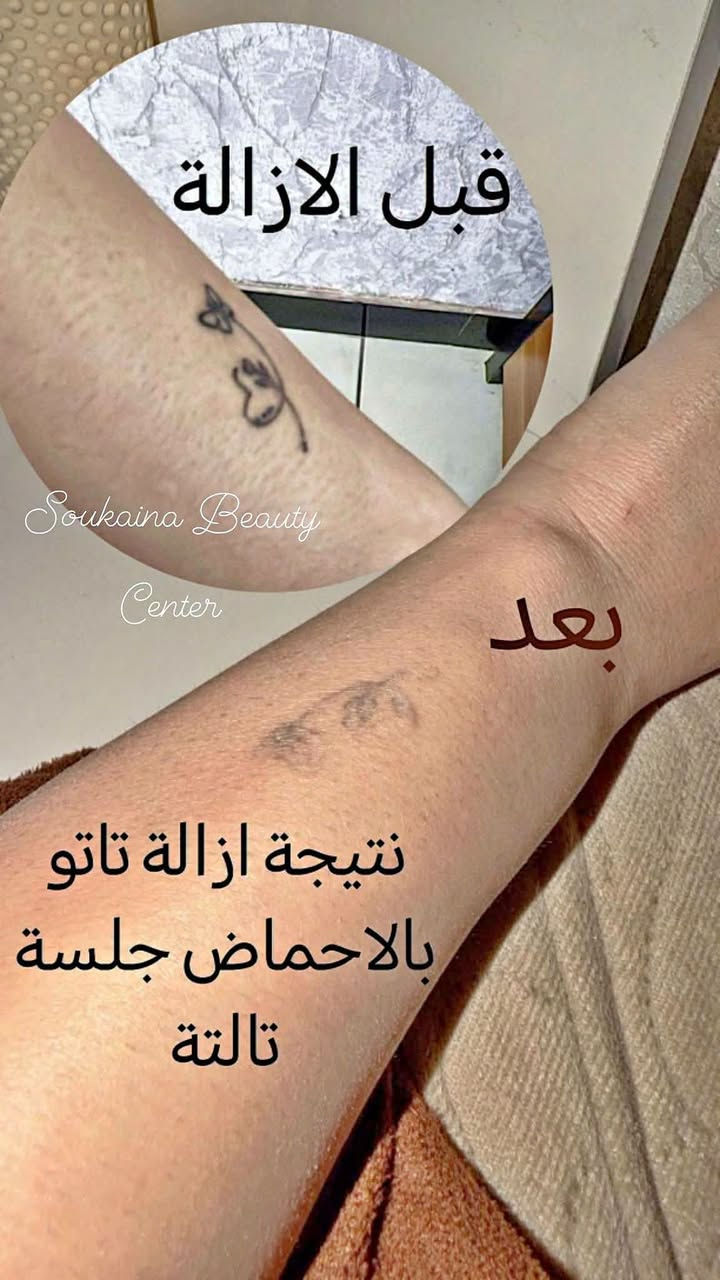 إزالة تاتو • ٣ جلسات • فيريموفل نانو