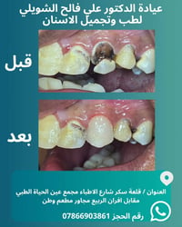 حشوة ضوئية • تجميل أسنان • قلعة سكر