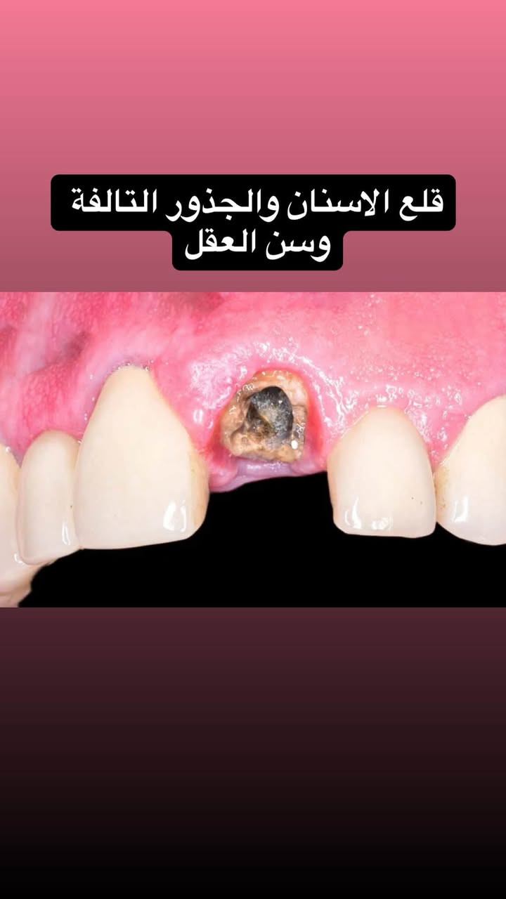 السلام عليكم العلاج مجاني بالكامل تحت اشراف اطباء مختصين
تتوفر ايضاً زرعات الاسنان باسعار مناسبة
الي يحب يتفضل يتواصل ويايه واتس اب 

‭+٩٦٤ ٧٨٣ ٨٧٩ ٨١٧٤‬

نص مكتوب في الصور:
- Dr. Elaph Hafid
- الدكتورة إيلاف حافظ
- قلع الأسنان والجذور التالفة وسن العقل
- تنظيف الأسنان وازالة التكلسات
- معالجة التسوس بحشوات ضوئية للأسنان
- تعويض الأسنان المفقودة بطقم متحرك جزئي وكامل
- تقويم الاسنان
- حشوات الجذور
- معالجة أسنان الأطفال
- عيادات جامعة البيان/شارع مطار بغداد الدولي/قرب ساحة عباس ابن فرناس
- العلاج مجاني بالكامل تحت اشراف اطباء مختصين
- ***********
- معالجة اسنان الاطفال
- تعويض الاسنان المفقوده بطقم جزئي وكامل
- قلع الاسنان والجذور التالفة وسن العقل
- تنظيف الاسنان من التكلسات العميقة