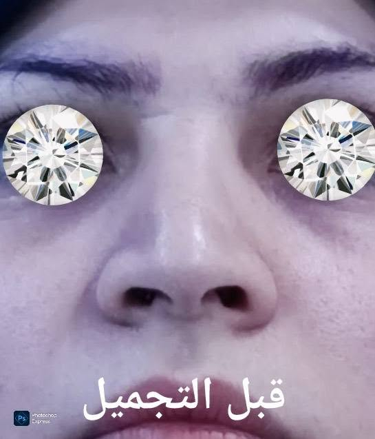 تجميل الانف • بعد رفع القالب • عيادة الياسيري