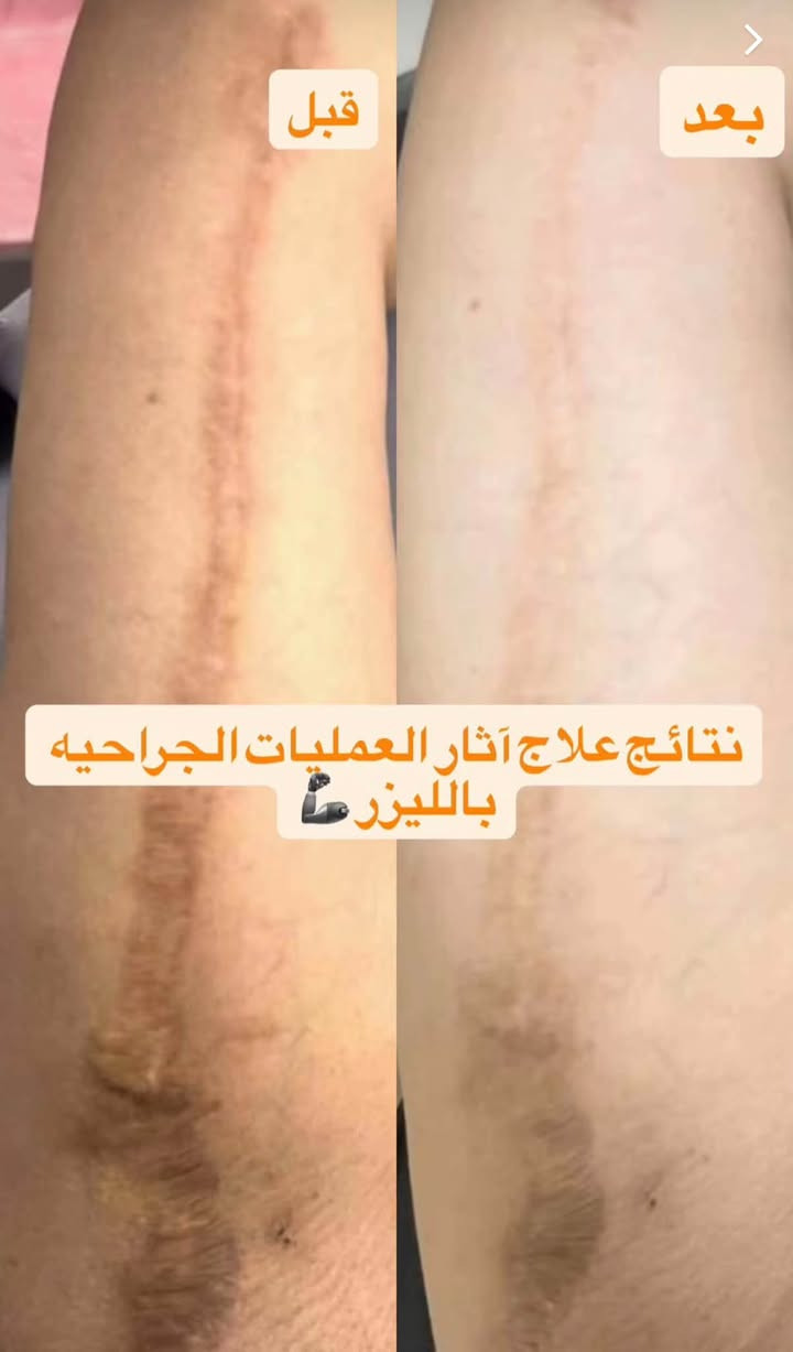 ✨ ودّعي آثار الجروح والعمليات القديمة ✨

ندب الجروح والعمليات ممكن تبقى لفترة طويلة وتأثر على مظهر البشرة، لكن مع ليزر CO2 Fractional نساعد على تحسين مظهر الندبات وتحفيز تجدد البشرة 🌿

🔹 علاج وتحسين مظهر الندب القديمة
🔹 آثار العمليات والجروح
🔹 تحفيز الكولاجين وتجدد البشرة
🔹 تحسين ملمس ومظهر الجلد
🔹 النتيجة تتحسن تدريجياً مع الجلسات حسب حالة الندبة

📍 عيادة Evora Clinic
📞 ***********
📌 حي الجامعة – قرب صيدلية السوسن
@إشارة

نص مكتوب في الصور:
- قبل علاج الندبات بالليزر بعد
- قبل بعد نتائج علاج آثار العمليات الجراحيه بالليزر
- قبل بعد