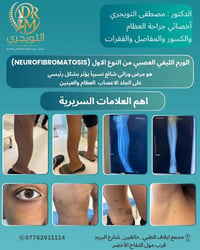 الورم الليفي العصبي • جراحة العظام • خانقين