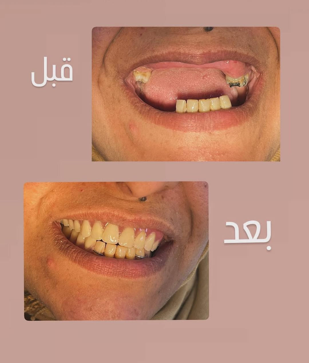 السلام عليكم 
إذا كنت تعاني من مشاكل الأسنان 
علاجك يمي 
اوفر لك 
حشوات ضوئية تجميلية 
تنظيف الأسنان وإزالة التكلسات والتصبغات 
قلع الاسنان التالفة والمتحركة والجذور المتبقية 
عمل طقم جزئي متحرك 

كل هذا والعلاج مجــاني بالكامــل  

المكان 
شـــارع فلـسطـيـن
 جــامعة المصـطفى 
للأستفــسار واتس أب ***********

نص مكتوب في الصور:
- قبل
- بعد