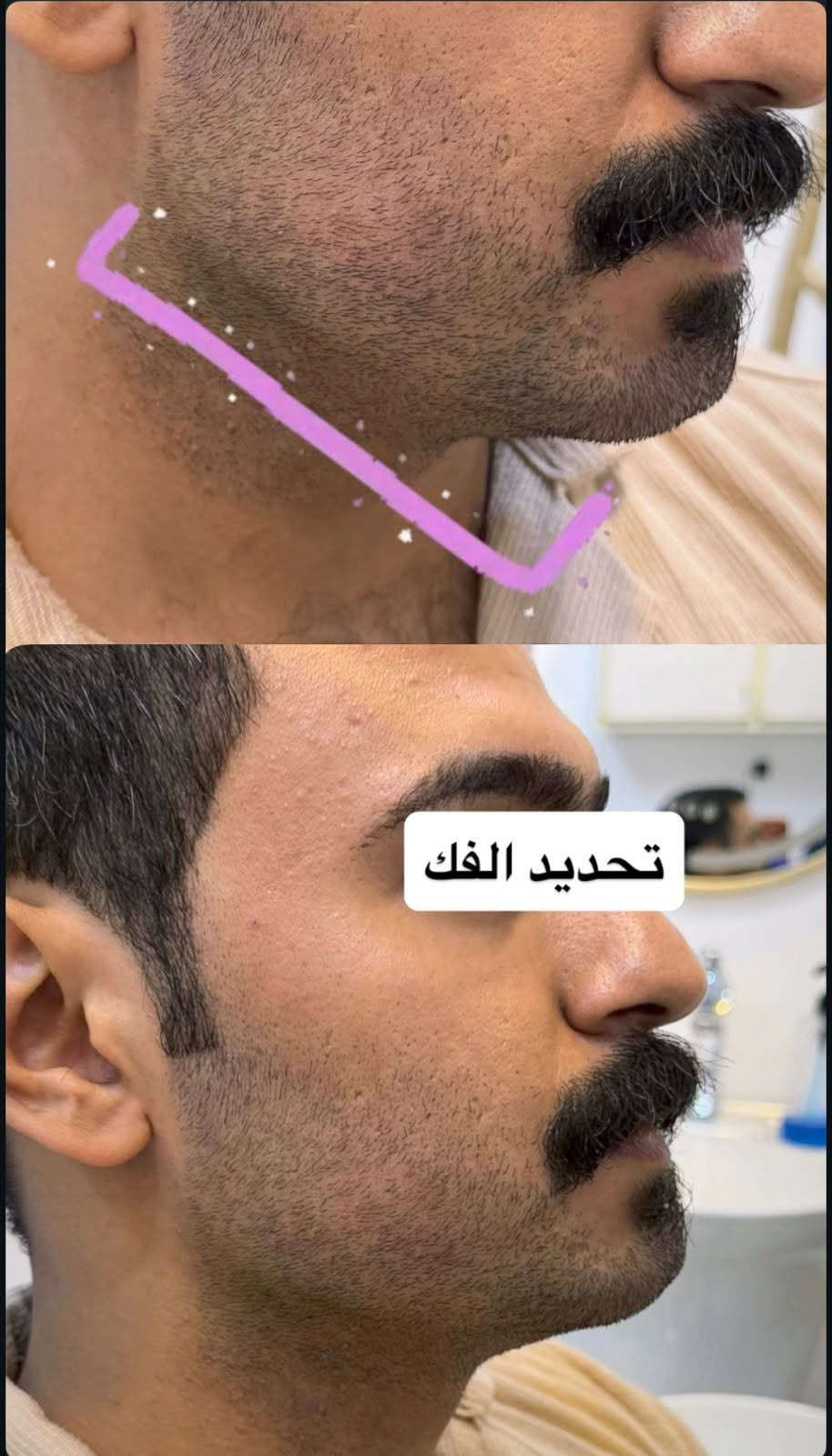 تحديد الفك • عيادة مون لايت • شغل اليوم