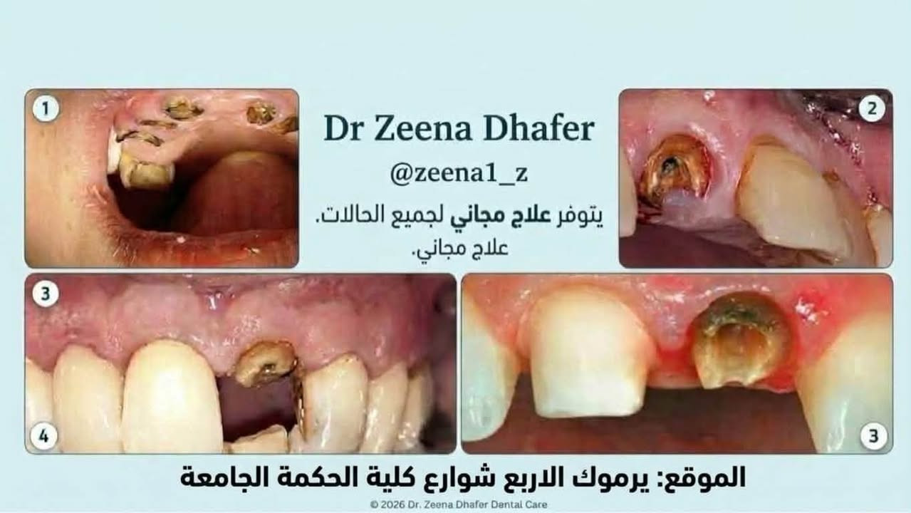 علاج مجاني • أسنان أطفال • يرموك كلية الحكمة