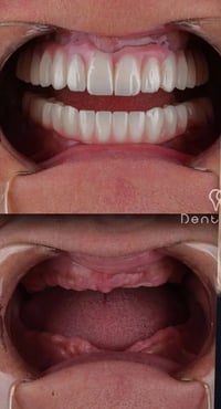 طقم اسنان متحرك • مجاناً • عيادات جامعة واسط