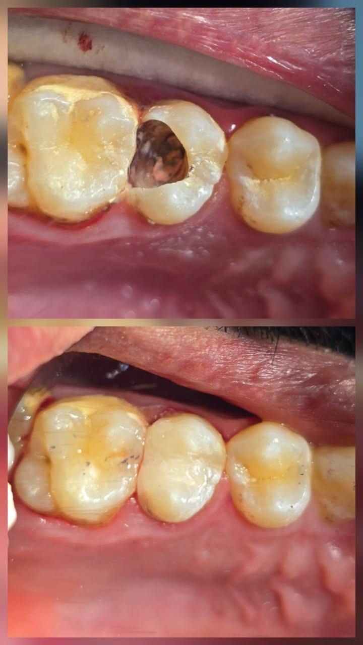 حشوه جذر مع بناء السن بالحشوه الضوئية 
عياده الاسكندريه لطب وتجميل الاسنان 
العنوان/ الاسكندريه ، خلف دائره الكهرباء ( مجمع الدكتور خالد عبد الخضر).
للحجز والاستفسار مراسله صفحه العياده او الاتصال على الرقم: 
***********
متواجدين يوميا من ٣ عصرا إلى ٩ باليل 

انستا العياده
 https://www.instagram.com/alexandria_clinic88?igsh=cjNtdWlmdWR1ODVu
الفيس 
https://www.facebook.com/share/1D2WrWPzQc/
