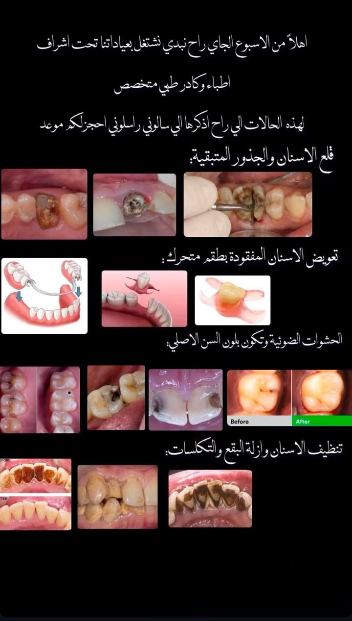 🦷 عندك مشكلة بأسنانك وتحتاج علاج؟

نستقبل حاليًا حالات علاج الأسنان مجانًا، وتشمل:

▫️ الحشوات الضوئية
▫️ قلع الأسنان وبقايا الجذور
▫️ تنظيف الأسنان وإزالة الجير والتصبغات
▫️ تعويض الأسنان المفقودة

👩🏻‍⚕️ يتم تقييم الحالة قبل العلاج، والعمل تحت إشراف أطباء اختصاص.

📍 بغداد، الدورة، شارع المصافي، عيادات كلية دجلة

📩 للحجز والاستفسار: ***********

***********

إذا تعرف شخص يحتاج علاج، شاركه المنشور 🤍🦷

نص مكتوب في الصور:
- DUCOD College Of Dentistry 2004 د. عبدالله فارس ستار كلية طب الأسنان - جامعة دجلة العلاج مجاني بإشراف أطباء اختصاص الخدمات المتوفرة تنظيف وتلميع الاسنان حشوات ضوئية طقم جزئي متحرك قلع الجذور المتبقية و الاسنان التواصل *********** *********** @dr_abdullah_fares @1_ym0 *********** كلية طب الاسنان - جامعة دجلة - الدورة - قرب تقاطع المصافي
- صباح الخير الي محتاج علاج التسوس و حشوة تجميلية يتواصل ويانه تحت اشراف كادر متخصص الي محتاج يتواصل ويانه *********** *********** مستشفي جامعه دجله علاج تسوس الاسنان بحشوات تجميلة الموقع: مستشفى جامعة دجلة - الدورة - قرب تقاطع المصافي
- صباح الخير الي محتاج تنظيف اسنان يتواصل ويانه تحت اشراف كادر متخصص الي محتاج يتواصل ويانه *********** *********** مستشفى جامعه دجله تنظيف وازالة التصبغات الموقع : مستشفى جامعة دجلة - الدورة -قرب تقاطع المصافي
- صباح الخير الي محتاج قلع اسنان اماميه يتواصل ويانه تحت اشراف كادر متخصص الي محتاج يتواصل ويانه *********** *********** مستشفى جامعه دجله الموقع :مستشفى جامعة دجلة - قرب تقاطع المصافي
- اهلا من الاسبوع الجاي راح نبدي نشتغل بعياداتنا تحت اشراف اطباء وكادر طبي متخصص
- لهذه الحالات الي راح اذكرها الي سالوني راسلوني احجز لكم موعد
- قلع الاسنان والجذور المتبقية:
- تعويض الاسنان المفقودة بطقم متحرك:
- الحشوات الضوئية وتكون بلون السن الاصلي:
- Before
- After
- تنظيف الاسنان وازلة البقع والتكلسات: