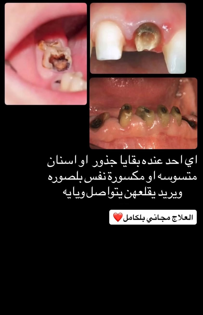 قلع أسنان • مجاني بالكامل • اليرموك