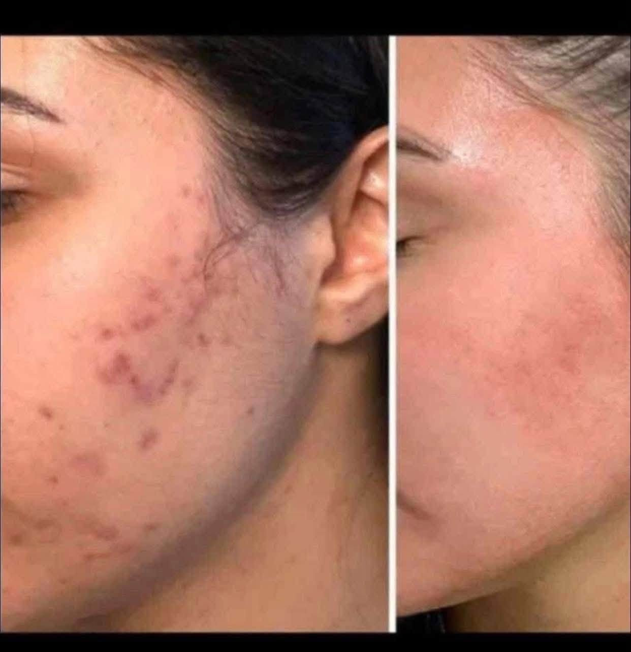 تۆش بەدەست کێشەکانی پێستەوە دەناڵێنی نازانی چی لێبکەیت و بەچی چارەسەری بکەیت🤔
کرێمێکت دەوێت بەگرەنتی👌 پارەگەڕانەوە ئەگەر سوودی نەبوو لەماوەی تەنها 🔺١٥ڕۆژدا
🟡سێتی کرێمی ئەمەریکی ئەڵلماس کەخاوەنی کوالێتی کۆنترۆڵە ☑️
ئەوەی ئەم کرێمەی بەکارهێناوە بۆهەمیشەیی ماڵئاوای لەتەواوی کێشەکانی ڕوخساری کردوە و دەوروبەری داوای ئەم کرێمەیان لێکردوە بەهۆی سوودو گۆڕانکاریە زۆرەکەیەوە 👍
ئەم کرێمە چارەسەری تەواوی ئەم کێشانەی ڕوخسارت بۆدەکات بەگرەنتیەوە 
🔺لابردنی زیپکەو شوێنەواری زیپکە
🔺لابردنیی پەڵەی سەرپێست و ژێرپێست
🔺لابردنی ڕەشی ژێرچاوو یەک ڕەنگ کردنی روخسار بەتەواوی
🔺لابردنی سوتاوی بەرخۆرو نەرم کردن و سافکردنی دەماوجاوو بەگشتی یەک ڕەنگردنی 
🟡کارتی گرەنتی و زەمانی بەکارهێنانی لەگەڵدایە سوودی تەواوت وەرنەگرت قەرەبوی تەواو دەکرێیتەوە 
بۆداواکردن و زانیاری زیاتر پەیوەندی بەم ژمارەیەوەبکەن
🚕گەیاندنمان بەردەستە 
📞***********
