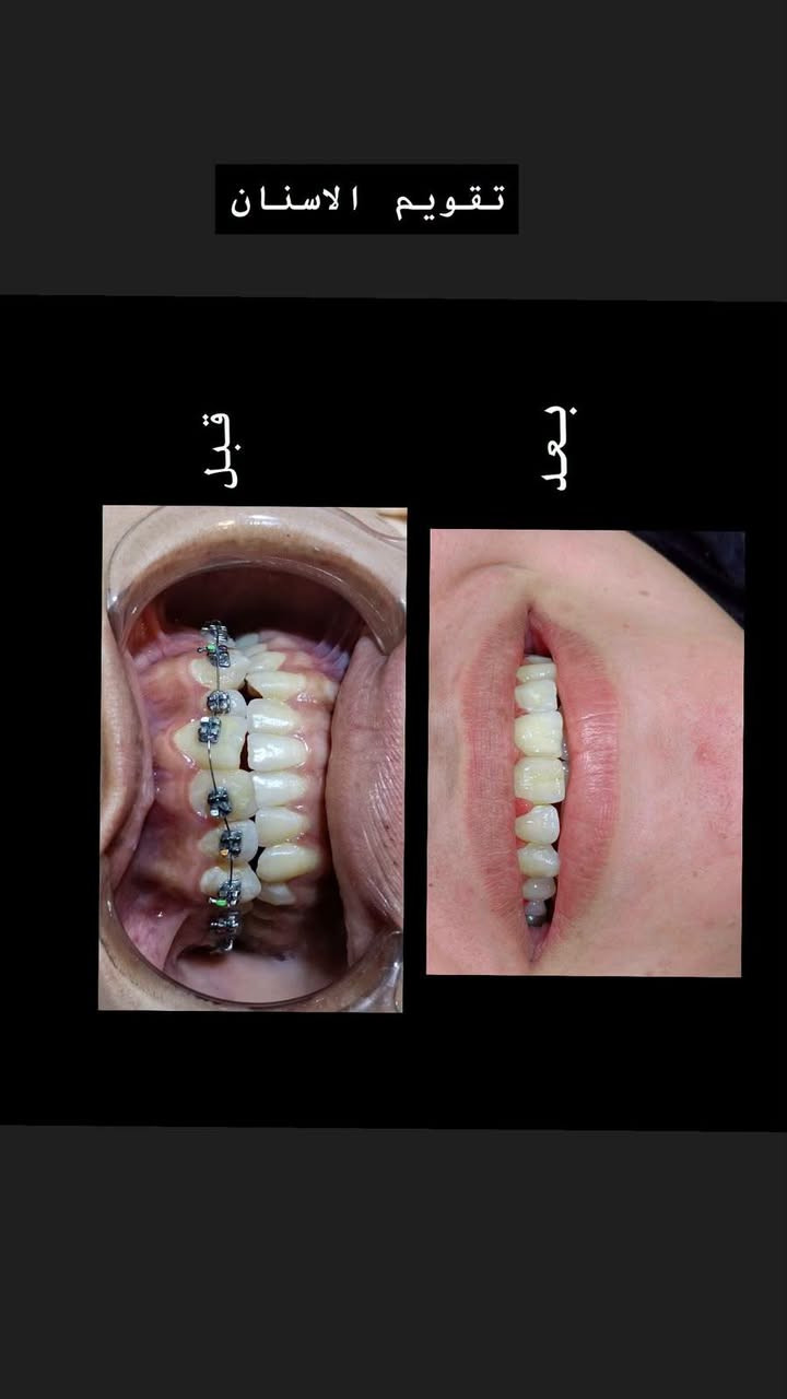 #عيادة طب الاسنان 🦷
#الدكتور فائق أحمد حمود 🩺🥼
#بكالوريوس طب وجراحة الفم والأسنان B.D.S
#يتواجد في العيادة من السبت إلى الخميس مساء 
☎️☎️0️⃣7️⃣8️⃣1️⃣9️⃣1️⃣8️⃣1️⃣8️⃣3️⃣5️⃣♻️📶
♦️يتوفر زراعة الاسنان. ♦️تقويم الاسنان ♦️تركيب الاسنان الثابته والمتحركه. ♦️قلع الاسنان. ♦️تنظيف وتبييض الاسنان بالليزر.♦️ حشوات تجميليه. ♦️حشوات بلاتين. ♦️حشوات الجذور 
#العنوان. الحويجه. شارع الاطباء. الفرع الثاني.
 #مجمع الكندي  الطبي.🏥 
للحجز والاستفسار 
الاتصال على الرقم 📲
***********

نص مكتوب في الصور:
- قبل بعد
- تقويم الاسنان قبل بعد
