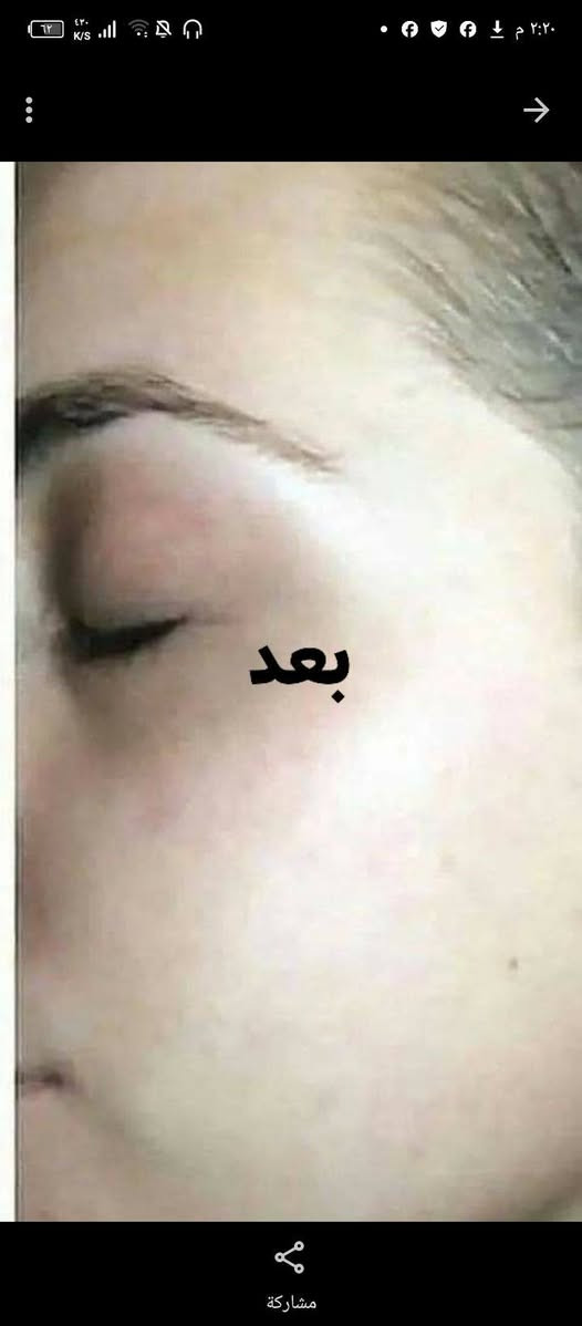 ✨ التصبغات وآثار الحبوب مو بس تغيّر مظهر البشرة، مرات تخلي لون البشرة غير موحّد وتحتاج عناية واهتمام مستمر.
بهالمنشور راح تتعرفين على أهم الأسباب، وتشوفين قبل وبعد من إحدى التجارب، وبالنهاية أشاركچ المنتج المستخدم في هذه التجربة: Forever Epiblanc 🤍🌿
إذا تعانين من التصبغات أو آثار الحبوب وتريدين تعرفين أكثر عن المنتج وطريقة استخدامه، راسليني خاص 💌
#فوريفر #Forever #Epiblanc #العناية_بالبشرة #التصبغات #آثار_الحبوب

نص مكتوب في الصور:
- بشرة صحية .. تبدأ من فهم الأسباب ♡
- أسباب التصبغات وآثار الحبوب
- التعرض المفرط للشمس
- تغيرات الهرمونات
- آثار الحبوب والالتهابات
- استخدام منتجات غير مناسبة للبشرة
- التوتر وقلة النوم
- العوامل الوراثية
- السبب معروف .. والحلم موجود ♡
- قبل
- بعد
- المنتج المستخدم في هذه التجربة
- Forever Epiblanc
- يساعد على توحيد لون البشرة وتقليل التصبغات
- يقلل التصبغات
- يوحد لون البشرة
- يمنح البشرة إشراقة طبيعية
- مناسب لجميع أنواع البشرة
- Healthy Skin Brighter You