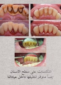 الدورة نهاية شارع ستين • تنظيف اسنان • قلع اسنان