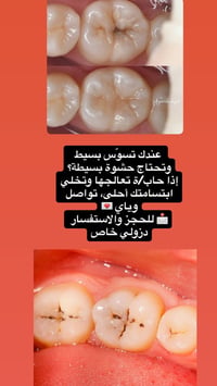 علاج مجاني • تنظيف اسنان • جامعة الكوت