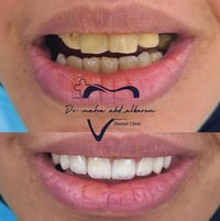 هوليود سمايل • زيركون ايماكس • خصم ٣٥٪