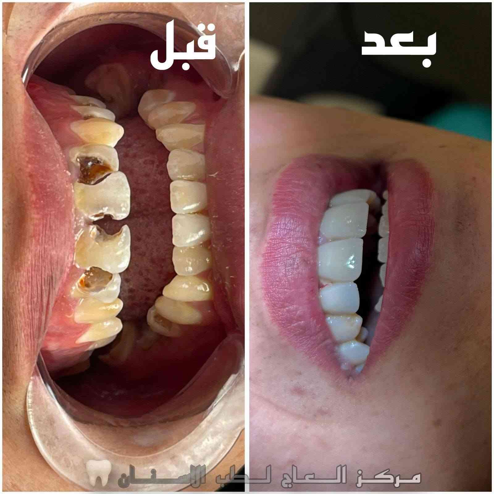 مركز العاج • الزبير • تنظيف اسنان