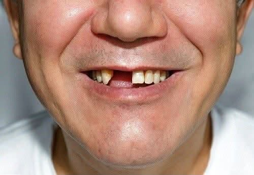 الرمادي • طقم اسنان متحرك • جامعة المعارف