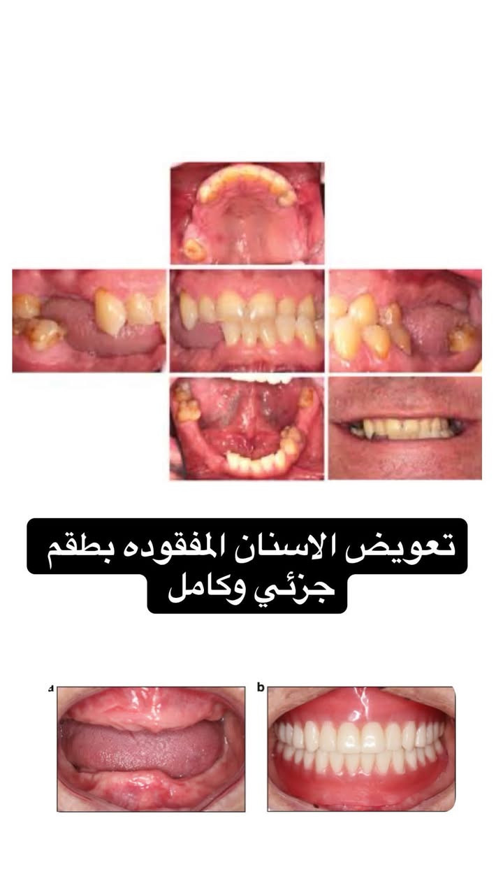 السلام عليكم العلاج مجاني بالكامل تحت اشراف اطباء مختصين
تتوفر ايضاً زرعات الاسنان باسعار مناسبة
الي يحب يتفضل يتواصل ويايه واتس اب 

‭+٩٦٤ ٧٨٣ ٨٧٩ ٨١٧٤‬

نص مكتوب في الصور:
- Dr. Elaph Hafid
- الدكتورة إيلاف حافظ
- قلع الأسنان والجذور التالفة وسن العقل
- تنظيف الأسنان وازالة التكلسات
- معالجة التسوس بحشوات ضوئية للأسنان
- تعويض الأسنان المفقودة بطقم متحرك جزئي وكامل
- تقويم الاسنان
- حشوات الجذور
- معالجة أسنان الأطفال
- عيادات جامعة البيان/شارع مطار بغداد الدولي/قرب ساحة عباس ابن فرناس
- العلاج مجاني بالكامل تحت اشراف اطباء مختصين
- ***********
- معالجة اسنان الاطفال
- تعويض الاسنان المفقوده بطقم جزئي وكامل
- قلع الاسنان والجذور التالفة وسن العقل
- تنظيف الاسنان من التكلسات العميقة