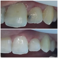 حشوات تجميلية • تجميل أسنان • عيادة أصلان