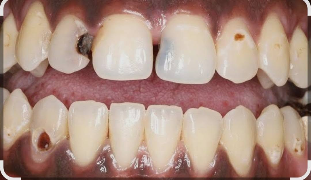 تسوسات اسنان • علاج مجاني • جامعة ابن سينا