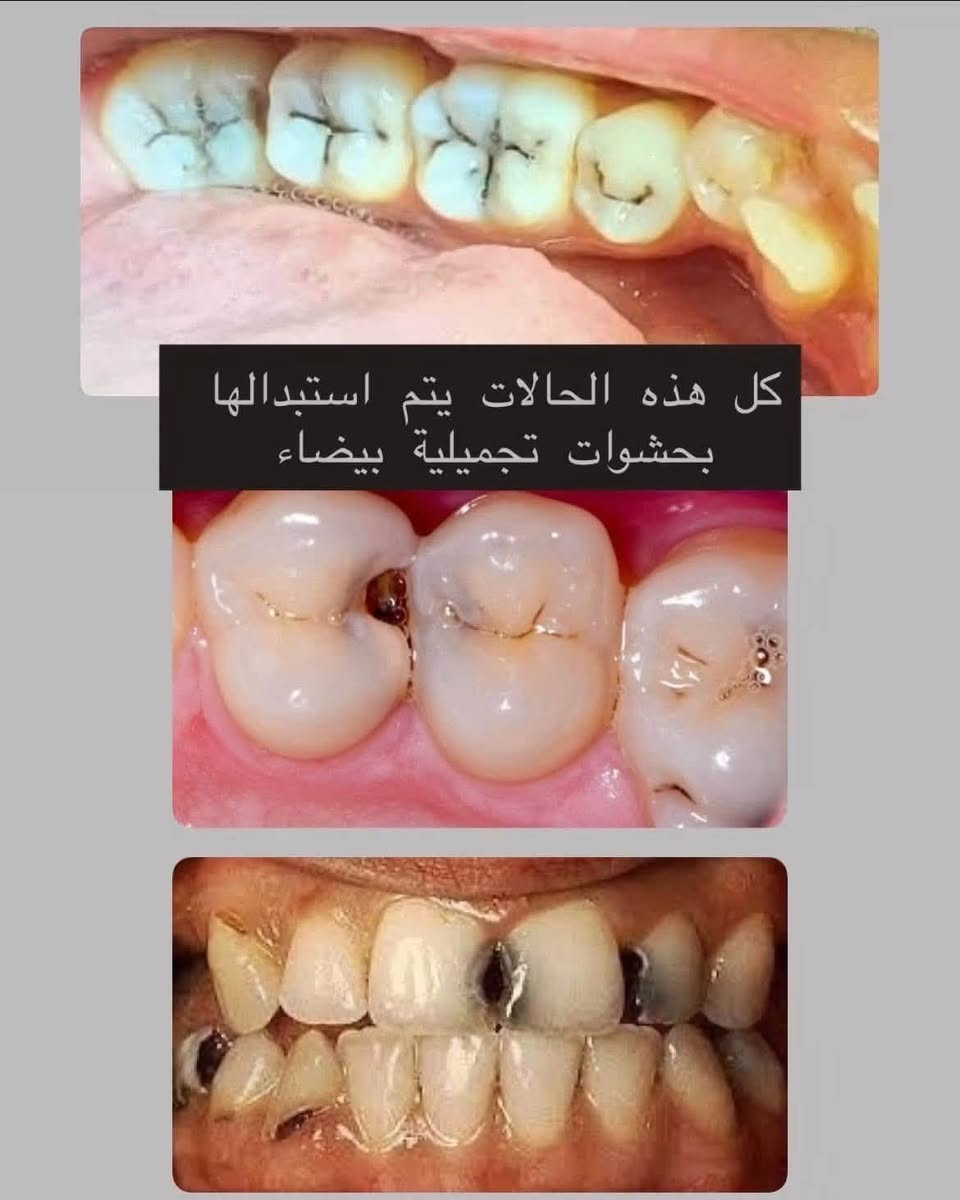 📢اي شخص محتاج
 

🟢قلع  (مجاني❤️)
🟢تقويم متحرك للاطفال فقط(40 الف فقط)
🟢حشوات بيضاء ودائمية  (6 الاف فقط)
🟢تنظيف اسنان   (4 الاف فقط)
🟢تعويض اسنان باطقم متحركة  (بحسب عدد الاسنان)
🟢علاج اسنان الأطفال بشكل كامل
🟢حشوات جذور للاسنان الامامية فقط(ذات الجذر الواحد) (20 الف فقط)

وشبه مجاناً✅✅✅

كل هاي الخدمات متوفرة بشكل شبه مجاني داخل كلية طب الاسنان في جامعة الموصل وتحت اشراف افضل الاطباء على مستوى العراق

الاعداد محدودة احجزوا هسة حتى يتثبت مكانكم

للحجز والاستفسار: *********** 
او مراسلة الصفحة
