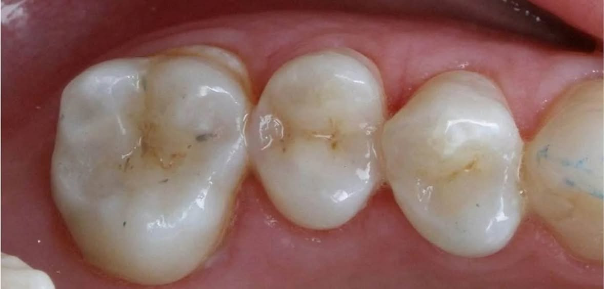 علاج مجاني الى اهالي البصرة  
حشوات تجميلية ، تنظيف الاسنان , قلع الاسنان والجذور النتبقية , تركيب طقم اسنان جزئي كل هذا مجاني تحت اشراف اطباء مختصين
للتواصل والاستفسار ***********

