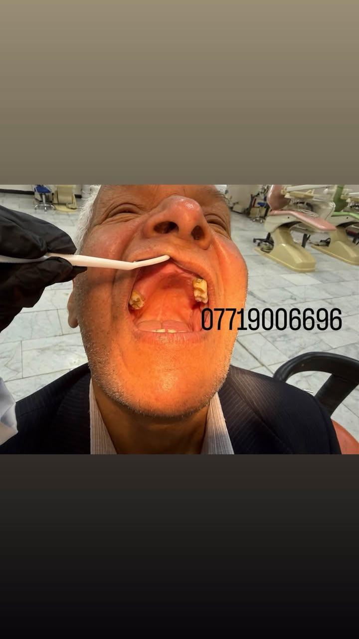 السلام عليكم شغل مجاني الي محتاج طقم اسنان يتواصل وياي***********

نص مكتوب في الصور:
- ***********