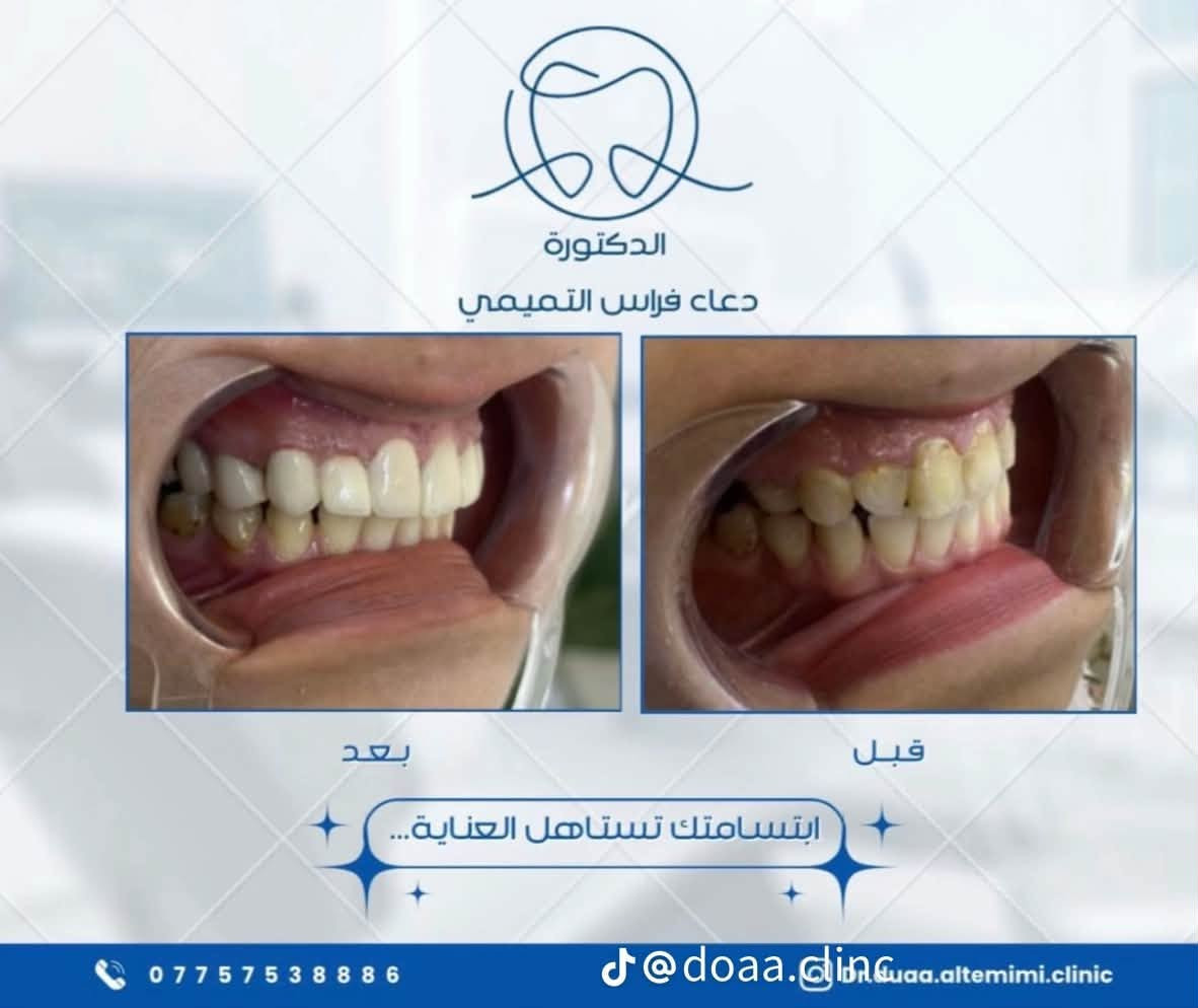 🦷عيادة الدكتورة دعاء فراس التميمي 🦷
-لعلاج الاسنان بالتقويم الشفاف والمعدني 

-زراعة الاسنان وعمل التراكيب السنية بالزاركون والسيراميك 

-عمل الحشوات التجميلية وحشوات الجذور 

-تنظيف وتبيض الاسنان بالليزر 

📍الكمالية - شارع الجامع  - مقابيل مثلجات الفريداوي 

🕠اوقات الدوام من الساعة 

4  مساءً الى الساعة  2 بعد منتصف الليل 

جميع ايام الاسبوع 

📞للحجز والاستفسار :

***********
