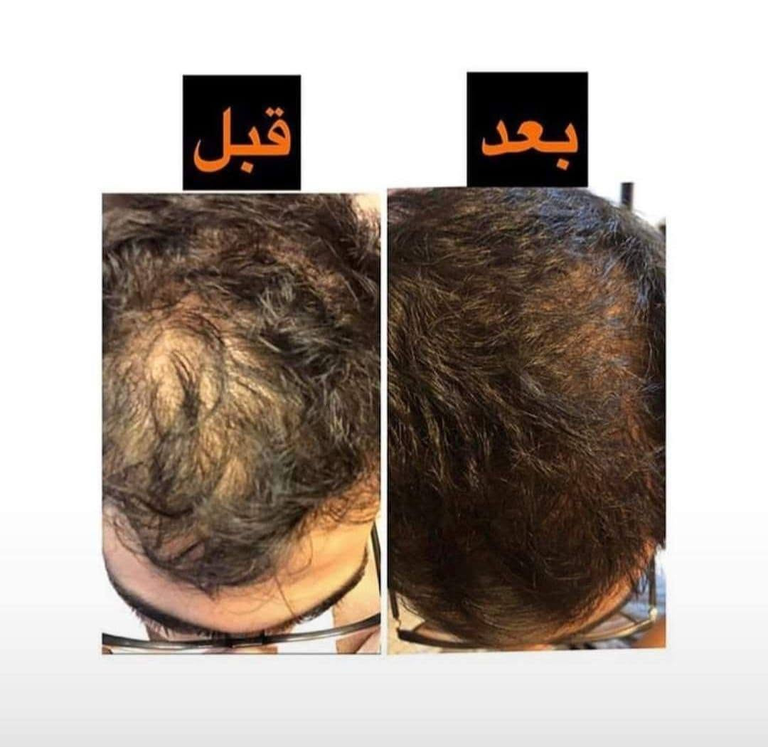 السلام عليكم :
الكتابة
✨ عناية لبشرتك… لأنك تستحق الأفضل ✨
نوفر لكم مجموعة مميزة من منتجات العناية بالبشرة للرجال والنساء 🧴💆‍♀️💆‍♂️
🇮🇷 منتجات إيرانية من شركة لدورة 🌿
💗 منتجات للنساء والرجال
💗 استشارة مجانية لاختيار المنتج المناسب
💗 متابعة الزبون كل أسبوع
💗 متابعة مستمرة وإرشادات لطريقة الاستخدام
📲 متواجدين على الواتساب للاستفسار والطلب:
***********
***********
✨ تواصلوا ويانا، والاستشارة مجانية ✨

نص مكتوب في الصور:
- بعد استعمال بكج التساقط من ماركة لدورا
- قبل بعد
- بشره تعاني من الكلف وحساسيه بالدم بعد استخدام منظف شيرباكون+مصل الكافيار لمدة ١٠ ايام
- بعد استخدام ١٠ ايام من المنتجات
- بعد
- قبل
- بعد استخدام عصاره الليكس