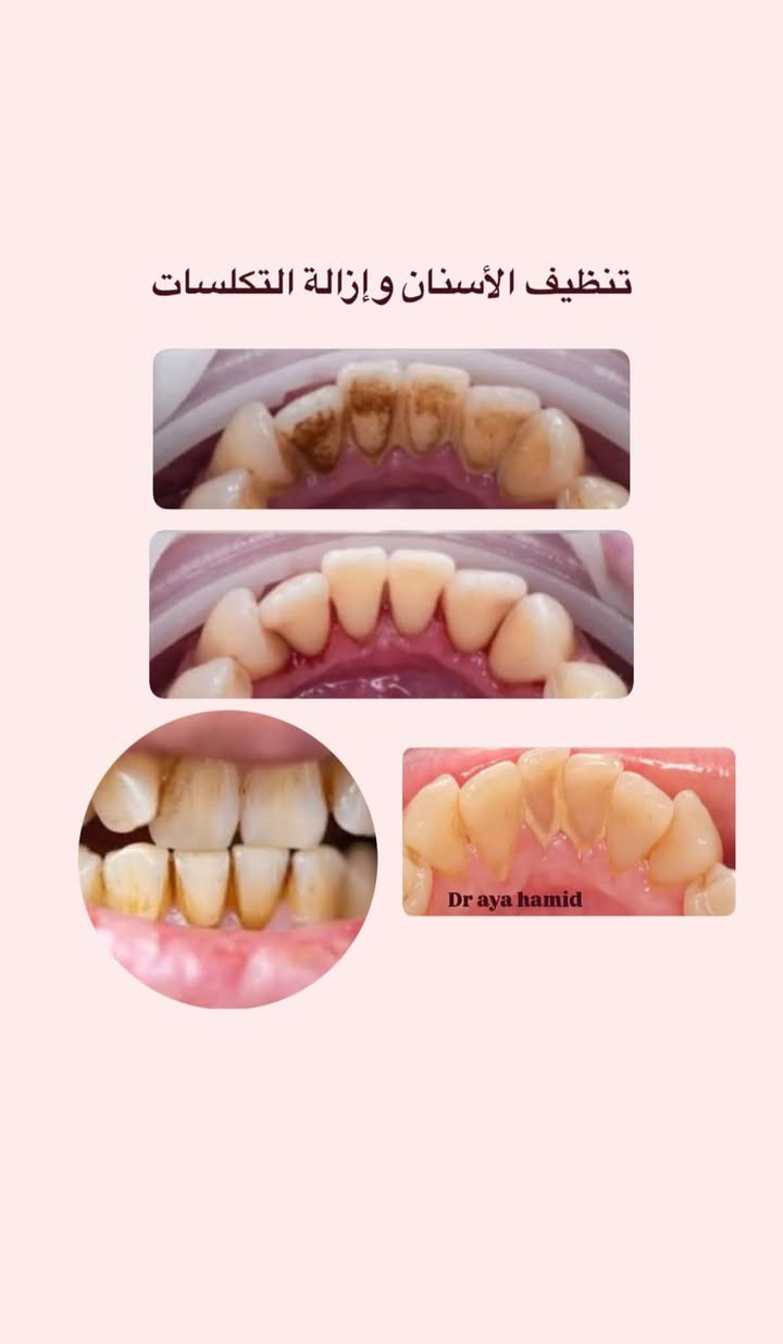 مجاناً مجاناً
السلام عليكم
انا طالبة طب اسنان اللي يحتاج
1. قلع للاسنان
﻿﻿﻿حشوات بيضاء تجميلية
﻿﻿﻿أطخم أسنان متحركة للاسنان المفقودة
﻿﻿﻿تنظيف للاسنان
خدمة مجاني بعيادة كلية النور الجامعة بحي الشلالات مقابل دجلة ستي
للتواصل عالواتس ***********
او علقو حسب حالتكم وانا اتواصل معاكم.

نص مكتوب في الصور:
- علاج التسوس بحشوات ( بيضاء ) تجميلية
- Dr aya hamid
- تنظيف الأسنان وإزالة التكلسات
- قلع الأسنان التالفة
- تعويض الأسنان المفقودة بطقم متحرك
- After
- Before