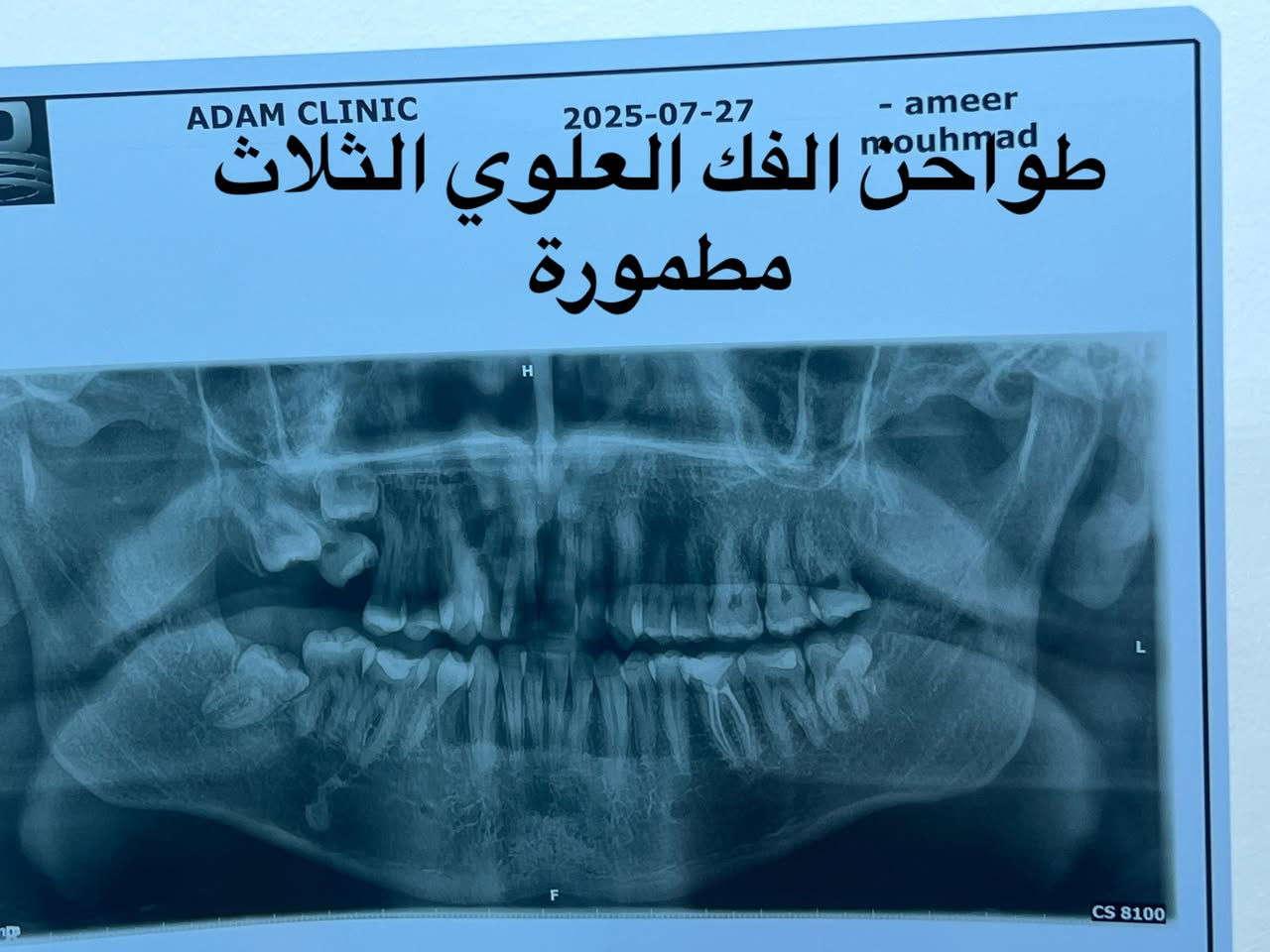 التقويم يميزنا احد حالات المعقدة و المستعصية ( الصور تتكلم عن الصعوبة) يعاني من مظهر خارجي غير متناسق غير مرغوب و انزعاجات حادة و صعوبة في تناول الطعام و اثناء الكلام بسبب الاسنان الطواحن الثلاثة في الفك العلوي مطمورة من الحالات النادرة جدا… علاج جميع الحالات الصعبة و المعقدة نتائج مضمونة خبرة طويلة في مجال الحالات المستعصية دقة في إتقان العمل ابتسامة مثالية اسعار مناسبة بالتقسيط المريح…. دكتور غزوان مزهر بغداد الكرخ نفق الشرطة بداية شارع الاطباء عيادة لوركا فوق صيدلية كنز النفق متوفر واتس *********** #تقويم_الاسنان #اطباء_تقويم_الاسنان #العضة_المعكوسة #العضة_المفتوحة #العضة_العميقة @تغليف_الاسنان_الزاركون @حشوات_الاسنان @زراعة_الاسنان @اطباء_تقويم_الاسنان @اطباء_الاسنان

نص مكتوب في الصور:
- ADAM CLINIC - ameer mouhmad التقويم يميزنا عن الصعبة و التحدي أتحدث الأسنان الطواحن الفك العلوي مطمورة
- تقدم الفك السفلي
- انعدم خط المنتصف
- طواحن الفك العلوي مطمورة
- ADAM CLINIC 2025-07-27 - ameer mouhmad طواحن الفك العلوي الثلاث مطمورة
