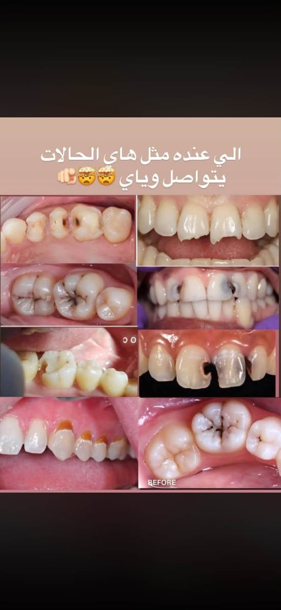 علاج مجاني • تنظيف أسنان • قبل وبعد