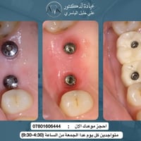 زراعة فك علوي • زرعات كورية • عيادة د.علي الياسري