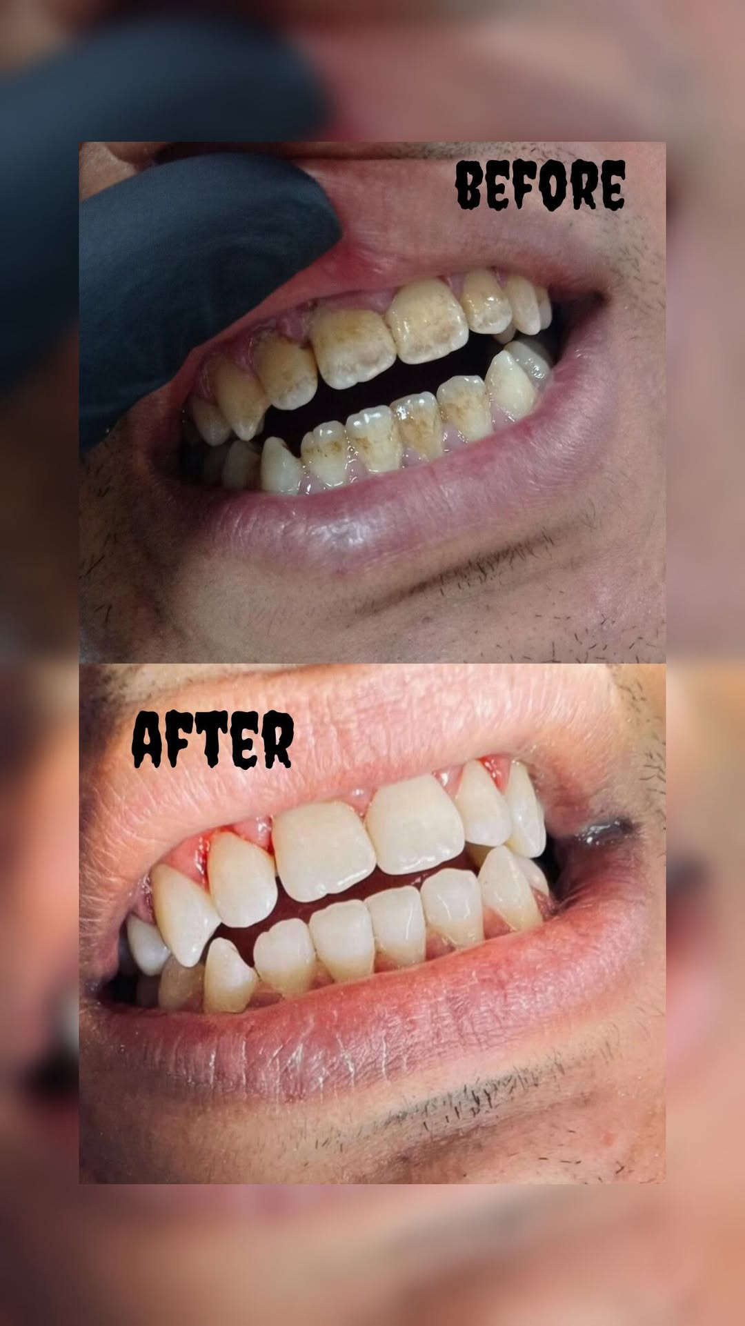 تنظيف الأسنان • مجاناً • جامعة العين