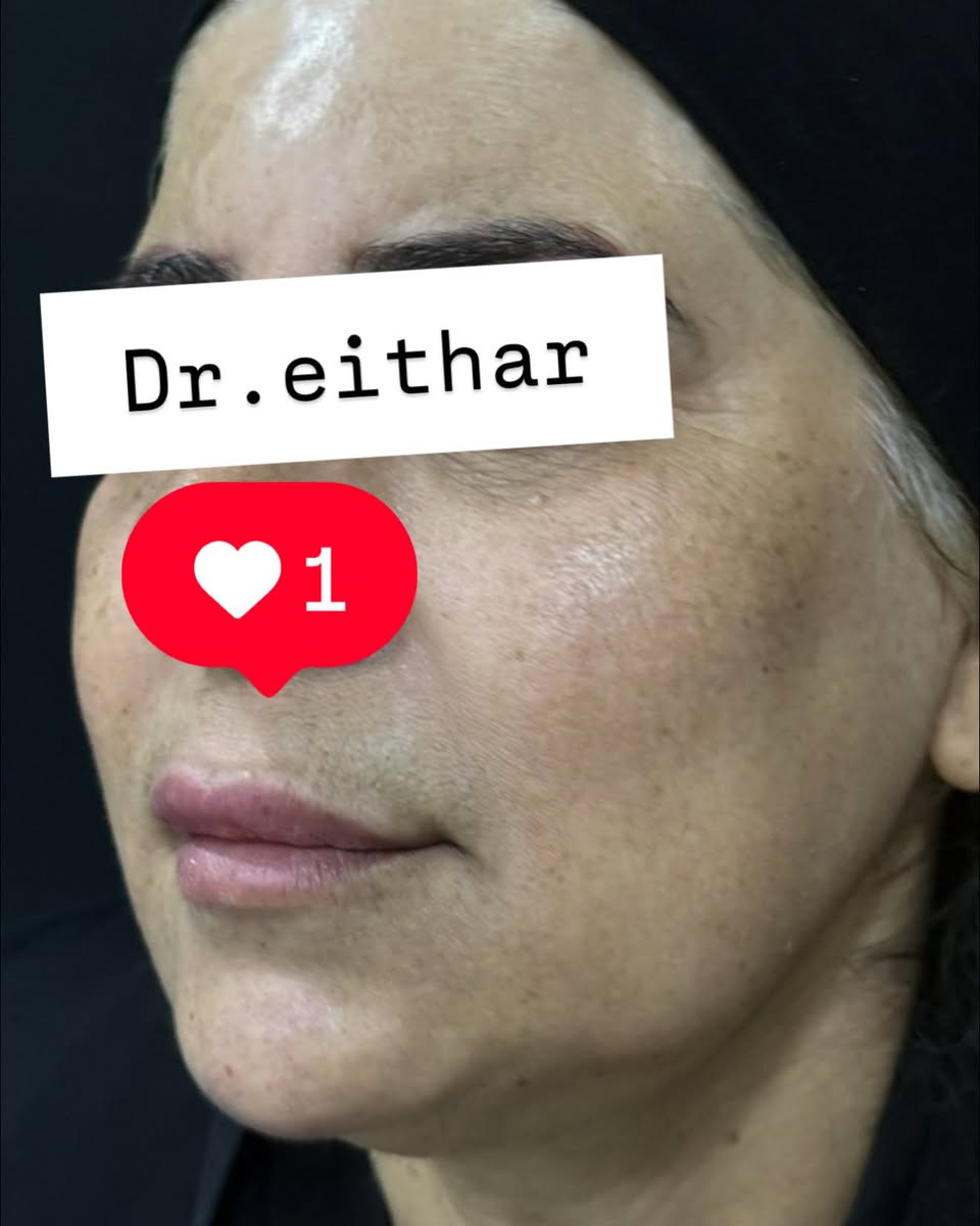 تجديد شد الوجه بالفلر  (لفتنك وجنات  واصداغ وتدوير الفك والذقن ونظاره وشفة سابقا حاقنتهه قبل سنه مجددناه لان متحتاج  ونظاره وبوتوكس  ) 🔥🔥🔥

اتمددت عروووض للكادر التدريسي والخريجات والموظفات والعروسات لنهايه الاسبوع ليوم الاربعاء اخر يوم  ثبتتهه الكم بالستوري بالهايلايت وببوست اعلى الصفحة ✨✨

د.ايثار سامي عبد الامير
واسط الكوت الهوره مجمع القبطان طابق اول 

الحجز***********

نص مكتوب في الصور:
- Dr.eithar
- 1
- Dr.eithar 1