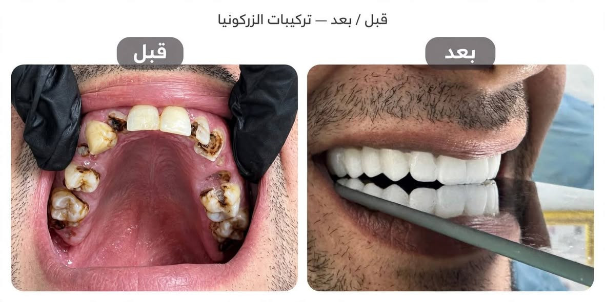 عبد الرحمن من الحالات الي تعاني من الم وتسوس ومدخن واحتاجينا التزام حتى وصلنا لهل ابتسامه دائما لاتخلون اسنانكم توصل لهيج مرحله ويجيبكم الالم جلسه ولا جلستين اثنين ولا اربعه اربعه ولا قلع شي أهون من شي مخسرانين شي الفحص مجاني وتدللون علينا وصحه وعافيه للجميع كحلو عينكم ب نتيجه عبد الرحمن🌸💚 الدكتورتنا الراقية د. فاطمة محمد عارية ♕🦷👑

نص مكتوب في الصور:
- قبل / بعد - تركيبات الزركونيا
- قبل
- بعد
- دكتورة فاطمة محمد عاريه الركابي المعالجه اسنانكم وبشرتكم متواجدة على مدار أيام الأسبوع وحتى يوم الجمعة نخدمتكم شرف لنا