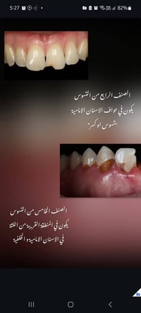 تنظيف الأسنان • إزالة التكلسات • جامعة اوروك