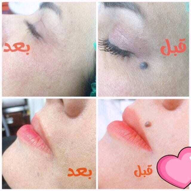 من شركة انزو الاصلية 💯💯 

جهاز ازالة الشام والزوائد اللحمية والفالول فعال ومضمون 🌺
جهاز ازالة الشامات والحبوب والزوائد  ( الفالول) 💯 ✔️ 
تستطيعين من خلاله ازالة الشامات غير المرغوبة ✔️
ازالة الزوائد نهائيا ✔️
ازالة الفالول وعدم عودته ✔️ ✔

جهاز عملي جدا وسهل الاستعمال يعمل عالشحن ويجب شحنه قبل استعماله 👍

السعر 25
🚘 يوجد خدمة توصيل لجميع محافظات العراق ٤ الاف 🚘
