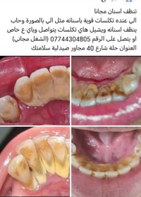 تنظيف اسنان مجاني • تكلسات قوية • حلة شارع 40