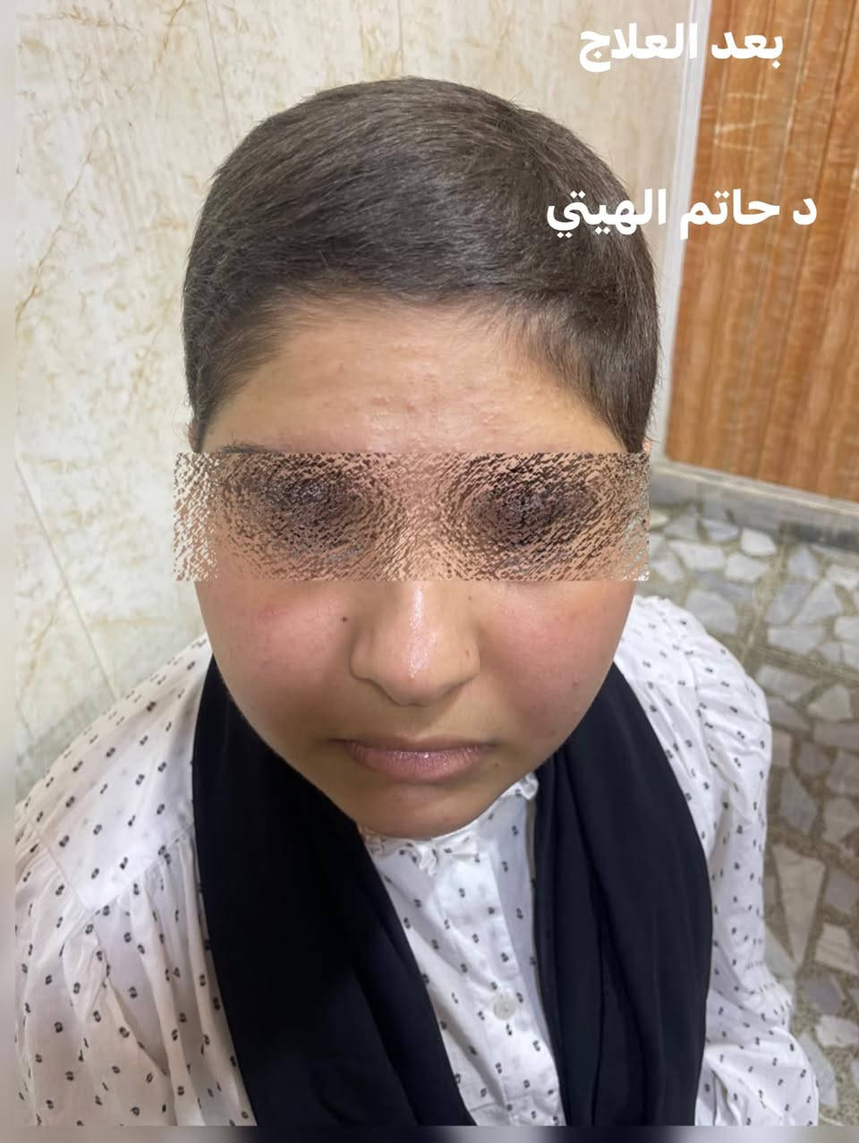 داء الثعلبة • قبل وبعد • د حاتم الهيتي
