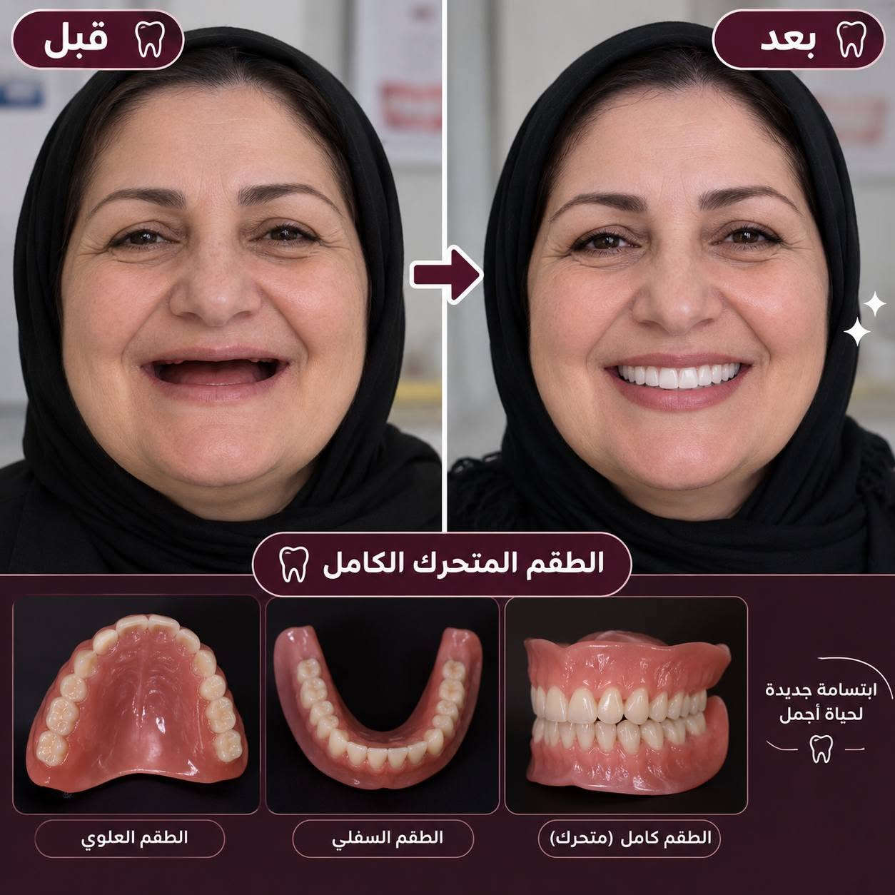 سلام عليكم اللي فاقد اسنانه بشكل كامل أو عنده احد فاقد اسنانه بشكل كامل وحاب يسويله تعويض يراسلني واتس ***********

وإذا عندكم أطفال من عمر 6 سنوات إلى 15 سنة وعندهم:

🔹 تسوس أسنان
🔹 حشوات أسنان الأطفال
🔹 جلسات فلورايد للوقاية والحماية من التسوس
🔹 تقويم أسنان
🔹 قلع الأسنان عند الحاجة وبعد الفحص

✨ لا تنتظرون ألم الطفل حتى يبدأ العلاج، الفحص المبكر يساعد على الحفاظ على أسنان أطفالكم 🦷🤍

نص مكتوب في الصور:
- ما هي جلسة الفلورايد؟ الفلورايد هو مادة آمنة توضع على أسنان الطفل في عيادة الأسنان، بشكل جل أو رغوة، وتساعد على تقوية مينا الأسنان وحمايتها من التسوس. فوائد جلسة الفلورايد يقوي مينا الأسنان ويجعلها أكثر مقاومة للتسوس. يقلل من نمو البكتيريا المسببة للتسوس. يساعد على إعادة المعادن المفقودة من الأسنان في المراحل المبكرة من التسوس. يقلل من حساسية الأسنان. يساهم في الحفاظ على صحة الأسنان لفترة أطول. الوقاية دائماً أفضل من العلاج أسنان قوية .. ابتسامة أجمل جلسة الفلورايد آمنة وسريعة ولا تسبب أي ألم، وتناسب جميع الأطفال من عمر 6 سنوات وما فوق. د. خيرات رافع - طب الأسنان - المرحلة الخامسة -
- التقويم المتحرك فوائده للأطفال التقويم المتحرك هو جهاز يُستخدم لتصحيح مشاكل الأسنان والفك عند الأطفال، ويُرتدى ويُزال بسهولة. مهم أن تعرفوا يختلف نوع التقويم المتحرك ومدته حسب حالة كل طفل وتطور نمو الفك والأسنان، لذلك من الضروري المتابعة مع طبيب الأسنان لتحديد الانسب لكل حالة. إغلاق الفراغات يقلل من وجود الفراغات بين الأسنان ويُحسن من شكل الابتسامة. تحسين المظهر العام يساعد على ترتيب الاسنان ويمنح الطفل ابتسامة أجمل وثقة أكبر بنفسه. تجنب مشاكل مستقبلية يقلل من احتمالية الحاجة إلى تقويم ثابت في المستقبل ويمتع تفاقم المشاكل. تحسين نمو الفك والأسنان يُوجه نمو العظام والفك بشكل صحيح، ويُساعد على ظهور الأسنان الدائمة بشكل سليم. توسيع الفك العلوي يساعد على توسيع الفك في حالات ضيق الفك، مما يهيئ مساحة كافية للأسنان الدائمة. تصحيح عضة الأسنان يساعد على معالجة مشاكل العضة مثل (العضة المتقاطعة، البروز أو التداخل بين الأسنان). د. خيرات رافع - طب الأسنان - المرحله الخامسة - للحجز والاستفسار *********** اسنان صحية ... مستقبل أجمل لأطفالنا
- قبل بعد الطقم المتحرك الكامل ابتسامة جديدة لحياة أجمل الطقم العلوي الطقم السفلي الطقم كامل (متحرك)