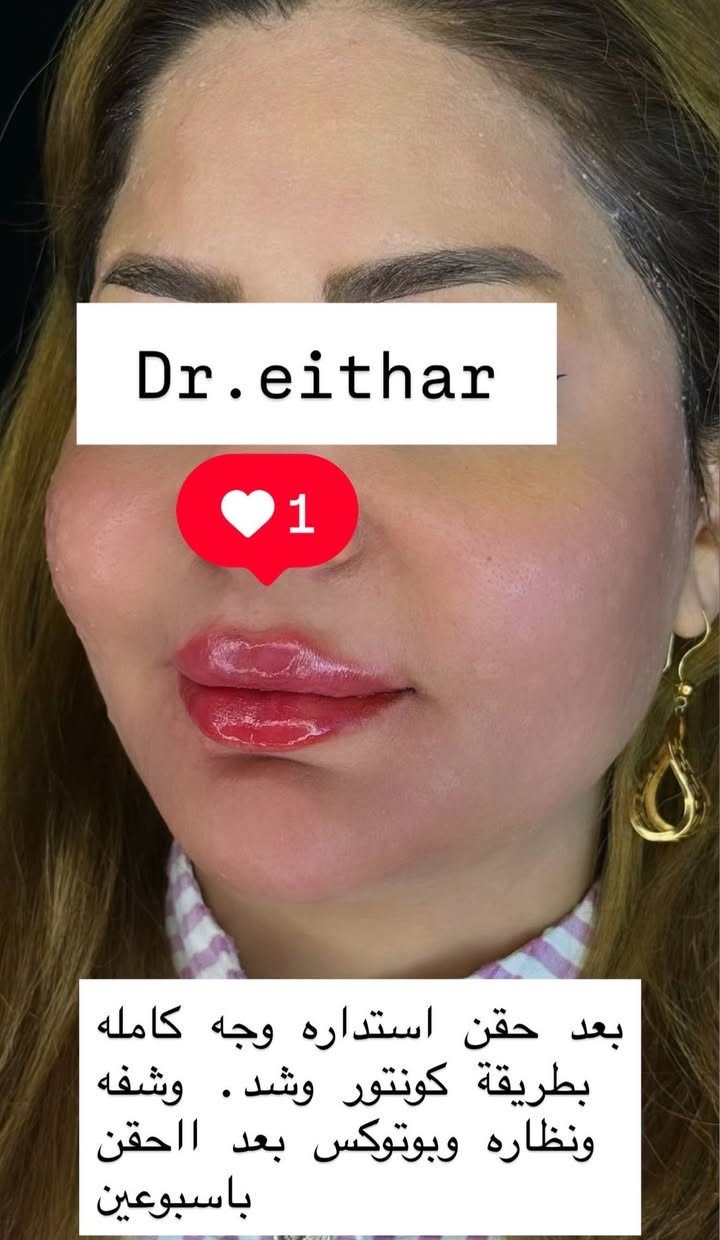 كونتور الوجه  (لفتنك وجنات  واصداغ وتدوير الفك والذقن ونظاره وشفة ونظاره وبوتوكس بعد الحقن باسبوعين ) 🔥🔥🔥

اتمددت عروووض للكادر التدريسي والخريجات والموظفات والعروسات لنهايه الاسبوع ليوم الاربعاء اخر يوم  ثبتتهه الكم بالستوري بالهايلايت وببوست اعلى الصفحة ✨✨

د.ايثار سامي عبد الامير
واسط الكوت الهوره مجمع القبطان طابق اول 

الحجز***********

نص مكتوب في الصور:
- Dr.eithar 1 تجديد لفتنك وجنات واصداغ وتدوير الفك والذقن وشغة ونظاره وبوتوكس
- Dr.eithar
- 1
- تجديد استداره وجه كامله
- وشفه ونظاره وبوتوكس
- Dr.eithar 1 بعد حقن استداره وجه كامله بطريقة كونتور وشد . وشفه ونظاره وبوتوكس بعد االحقن باسبوعين
- Dr.eithar 1 قبل التجديد
- قبل الحقن والصور الي بعد هي بعدالحقن باسبوعين