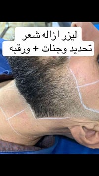 تحديد دائم • خط اللحية • ليزر ازالة شعر