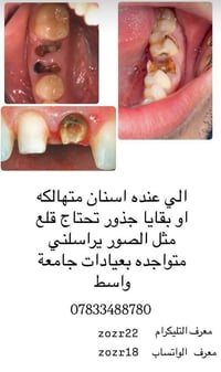 قلع أسنان • علاج مجاني • جامعة واسط