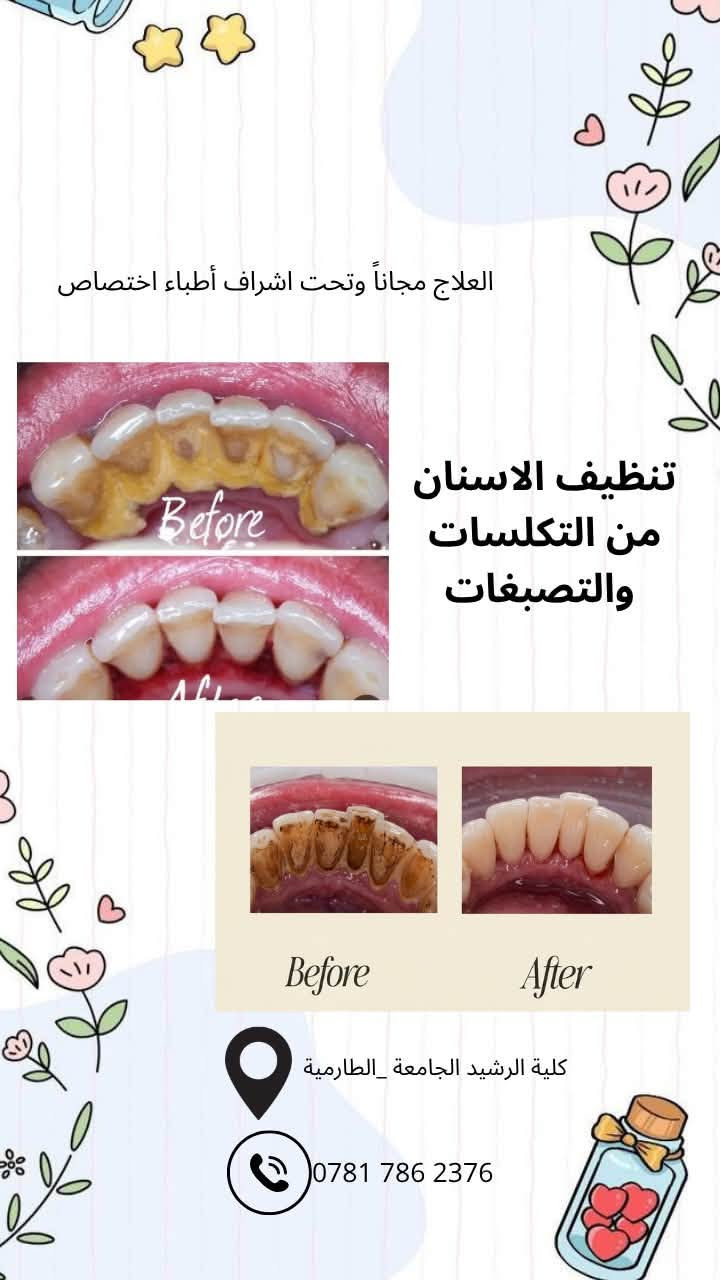 علاج أسنان مجاني • حشوات تجميلية • كلية الرشيد