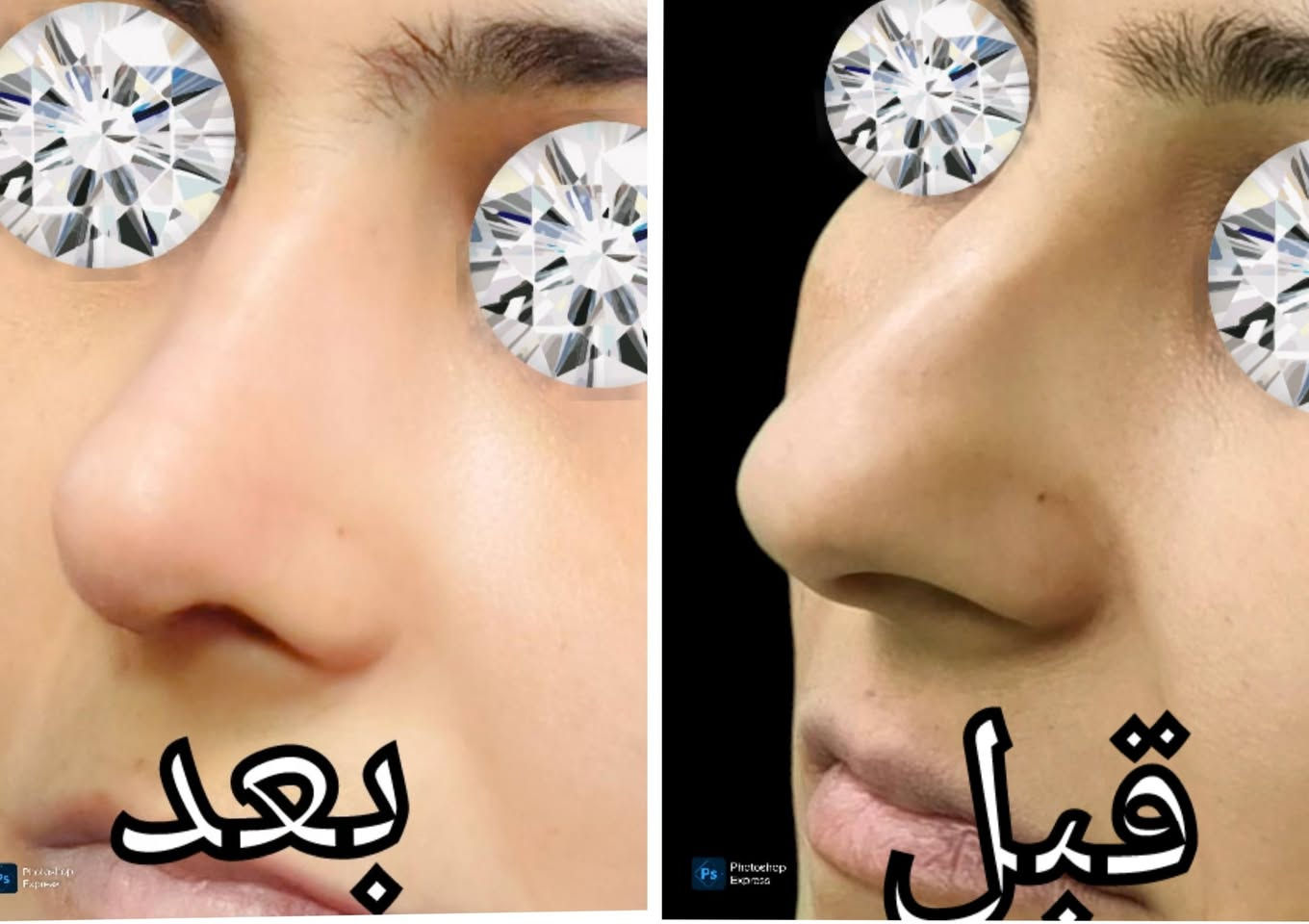 تجميل أنف • قبل وبعد • عيادة الياسري