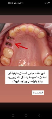 قلع مجاني • جذور اسنان • الدوره شارع ستين